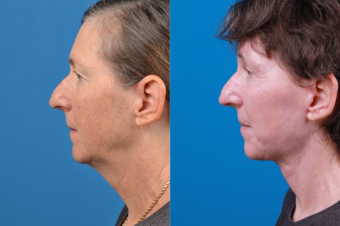 Facelift Before & After Gallery - Patient 122406170 - Image 3