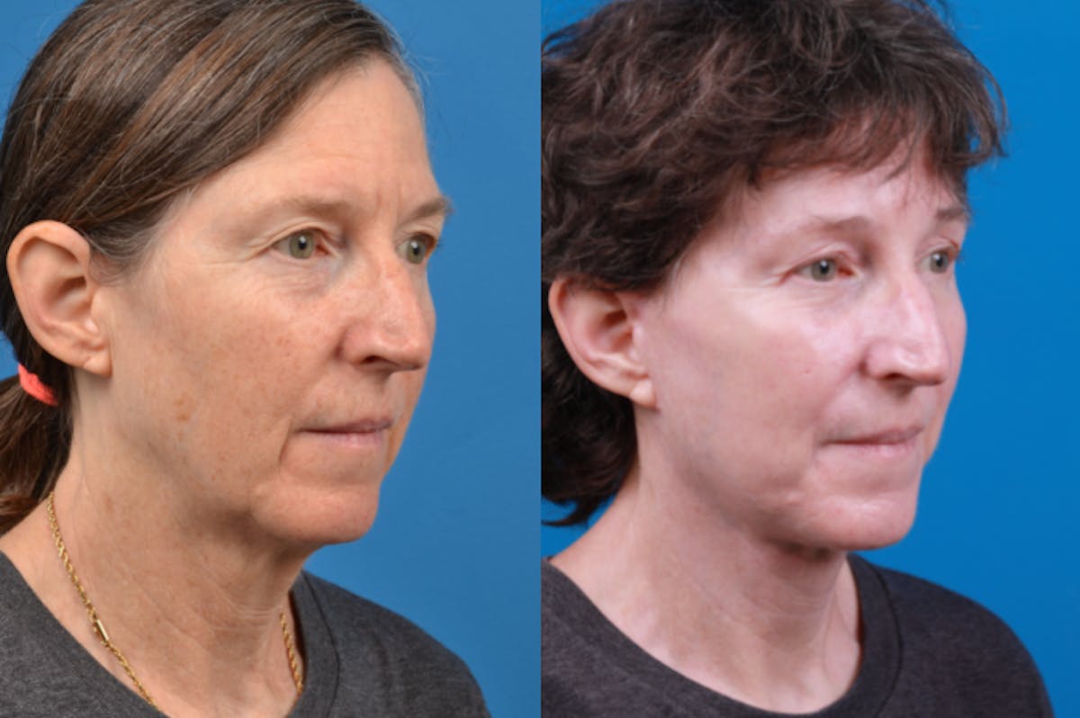 Facelift Before & After Gallery - Patient 122406170 - Image 4