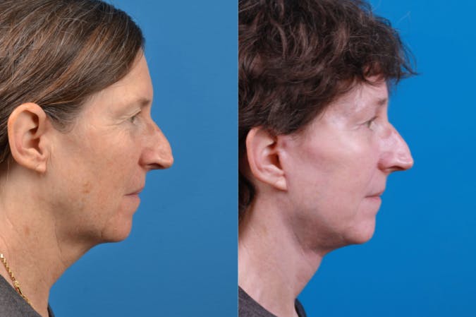 Facelift Before & After Gallery - Patient 122406170 - Image 5