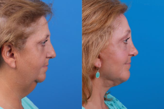 Facelift Before & After Gallery - Patient 122406172 - Image 5