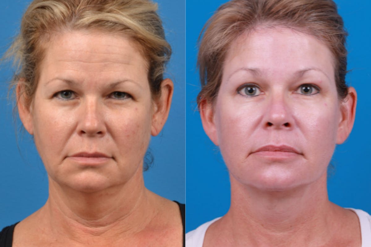 Facelift Before & After Gallery - Patient 122406174 - Image 1