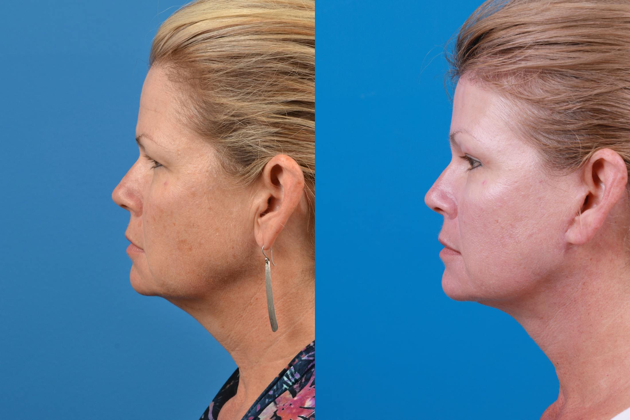 Facelift Before & After Gallery - Patient 122406174 - Image 2