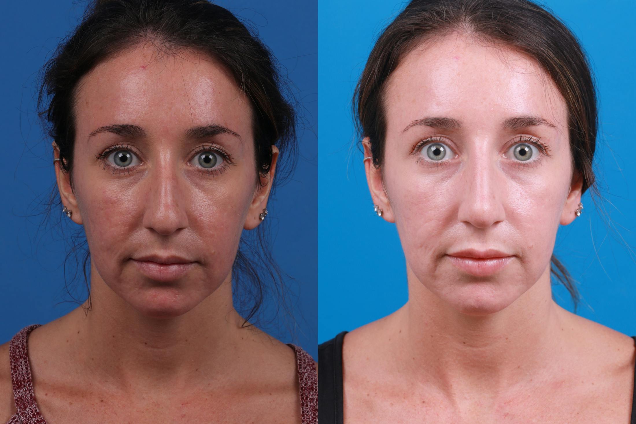 Liquid Rhinoplasty Before & After Gallery - Patient 122406173 - Image 2