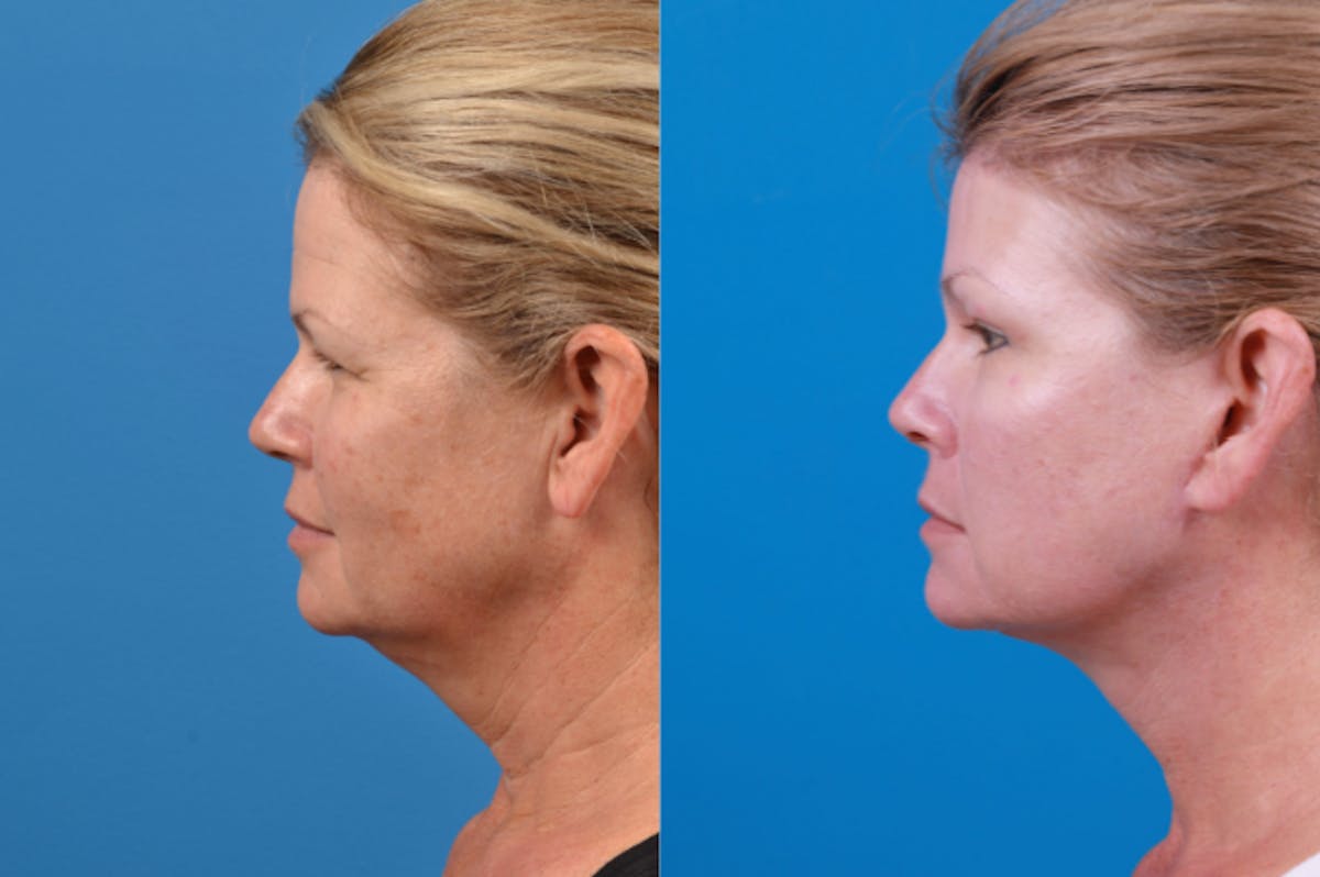 Facelift Before & After Gallery - Patient 122406174 - Image 3