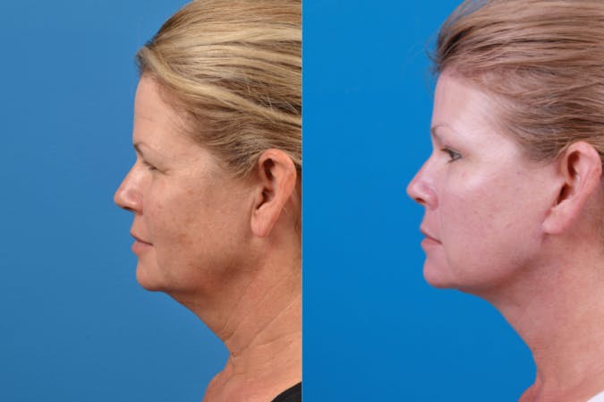 Facelift Before & After Gallery - Patient 122406174 - Image 3