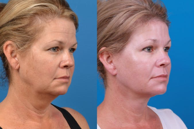 Facelift Before & After Gallery - Patient 122406174 - Image 4