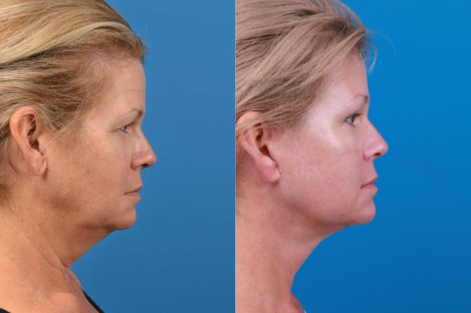 Facelift Before & After Gallery - Patient 122406174 - Image 5