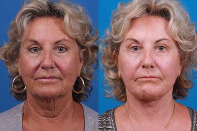 Facelift Before & After Gallery - Patient 122406175 - Image 1