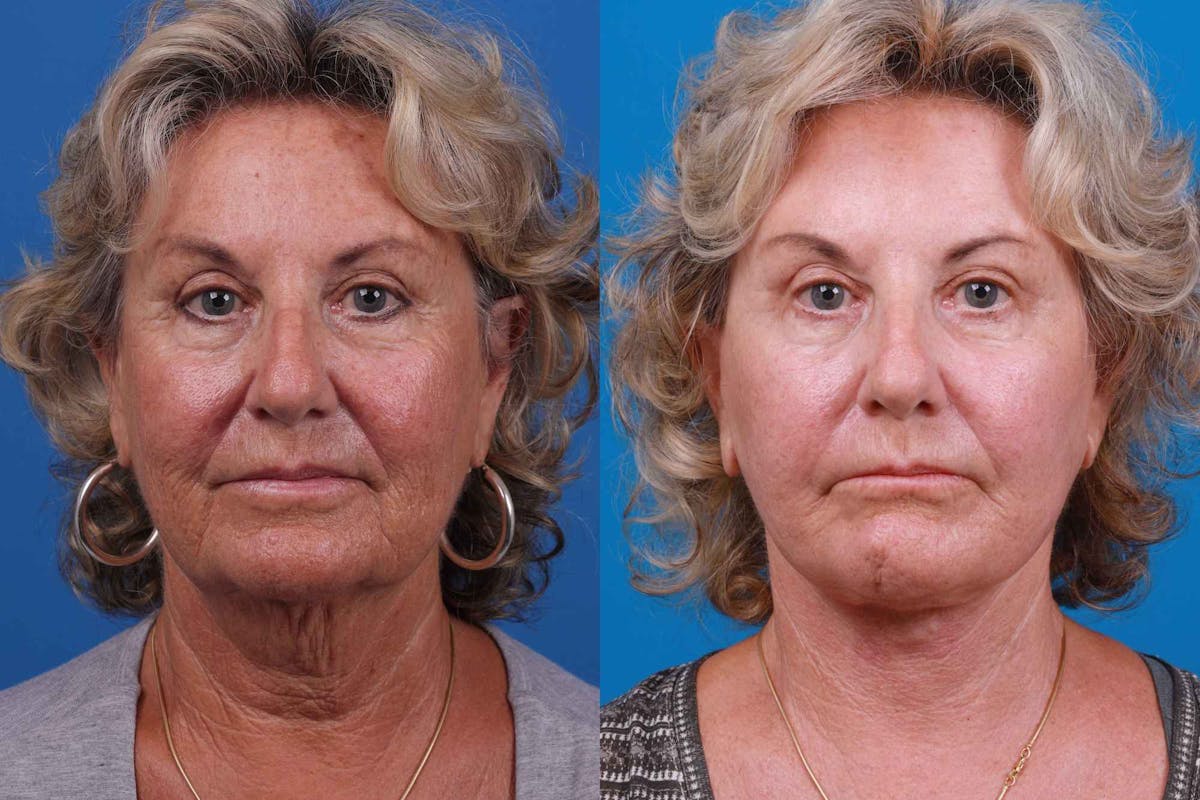 Facelift Before & After Gallery - Patient 122406175 - Image 1