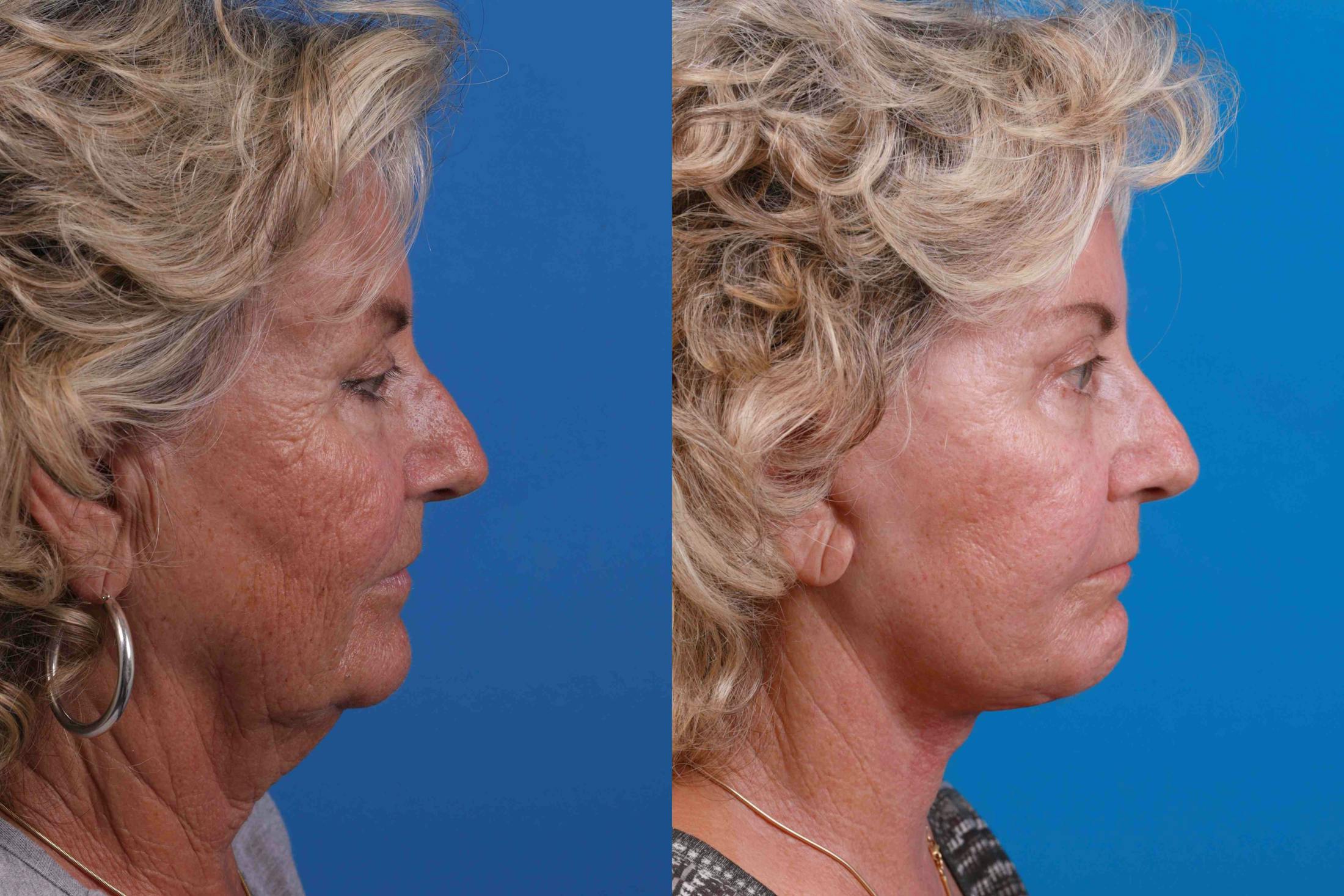Facelift Before & After Gallery - Patient 122406175 - Image 2