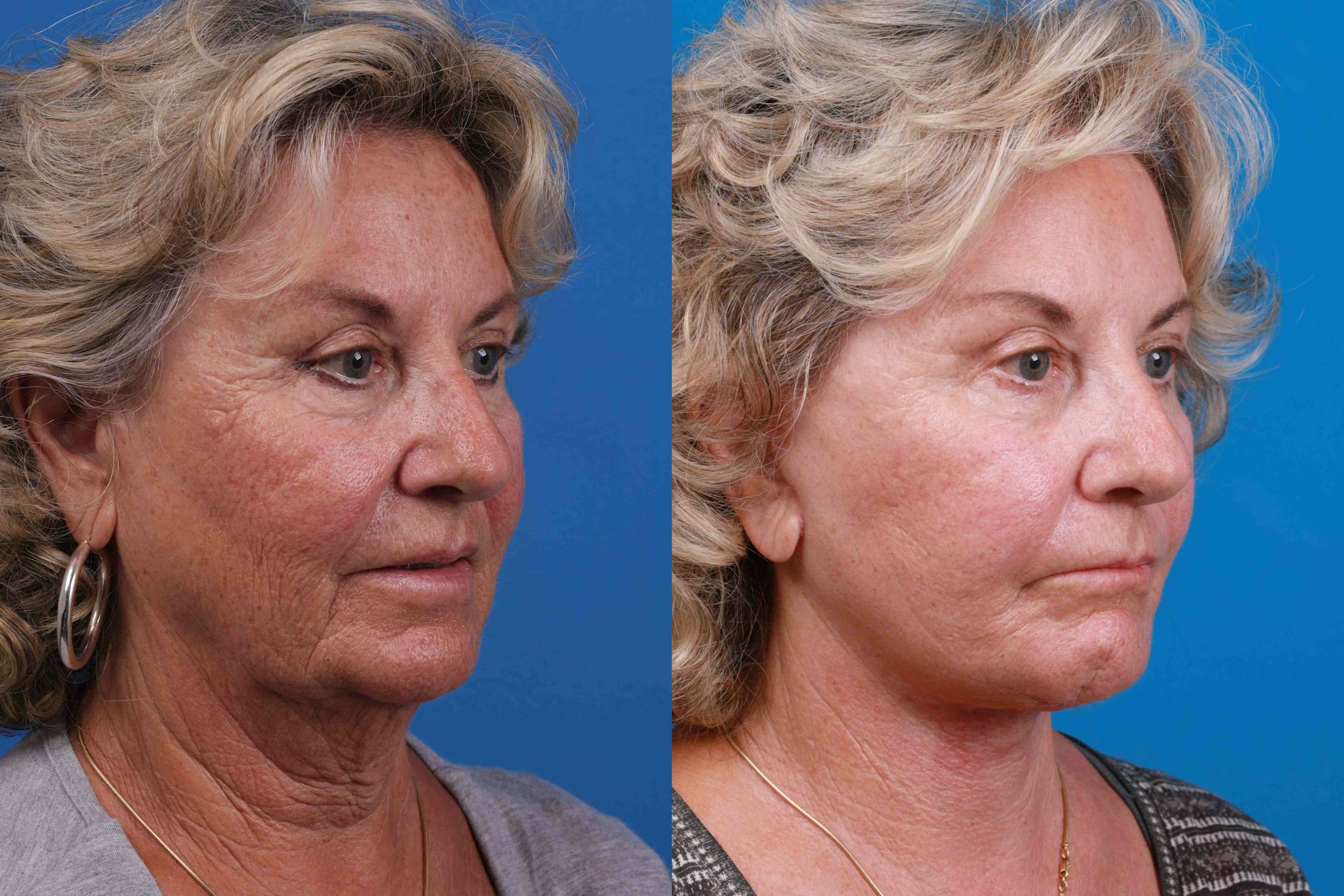 Facelift Before & After Gallery - Patient 122406175 - Image 3