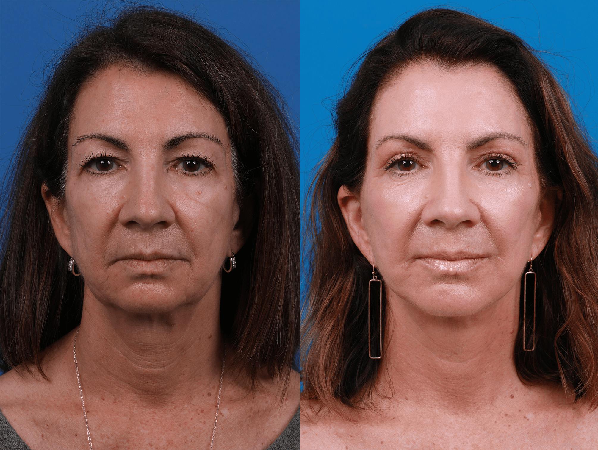 Facelift Before & After Gallery - Patient 122406176 - Image 1