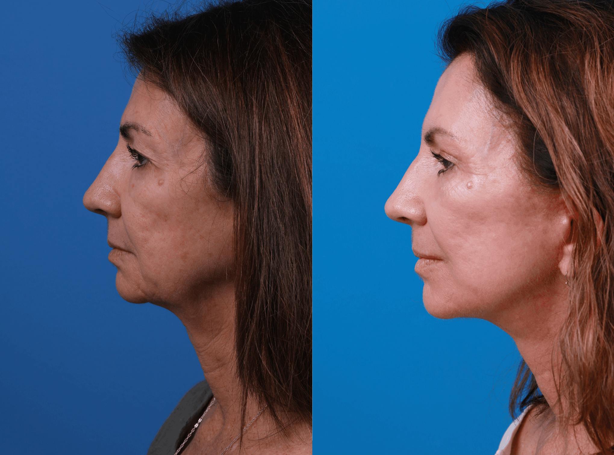 Facelift Before & After Gallery - Patient 122406176 - Image 2