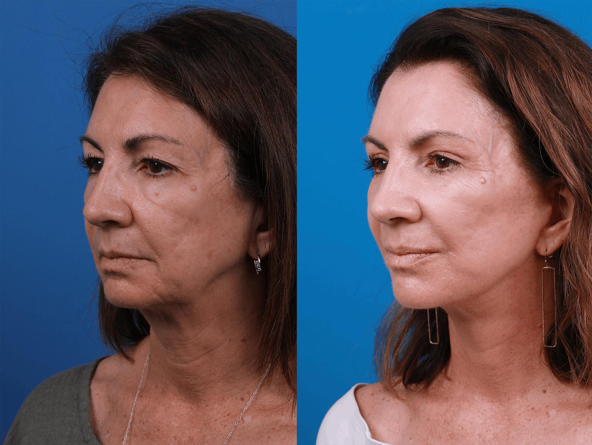 Facelift Before & After Gallery - Patient 122406176 - Image 3