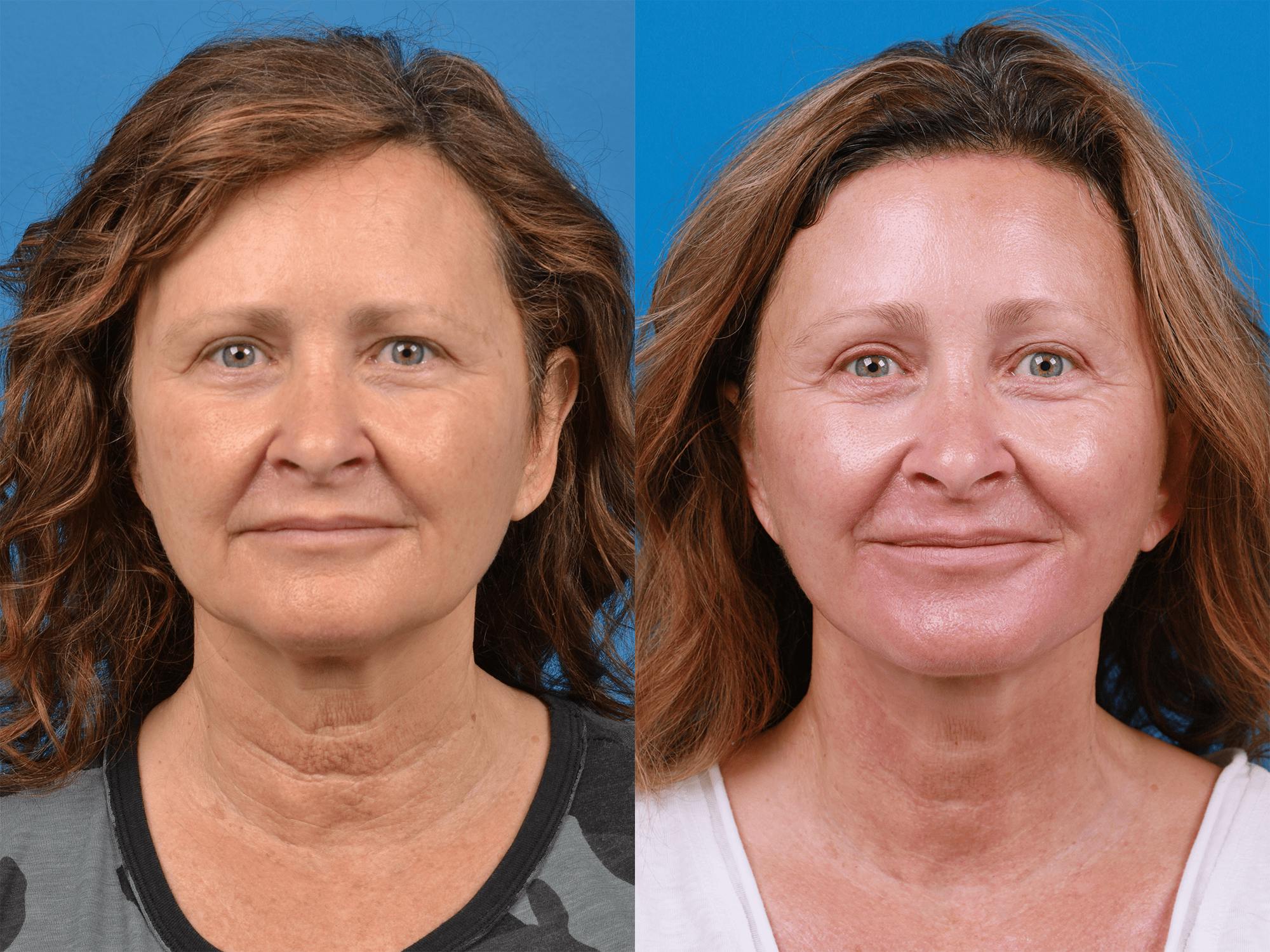Facelift Before & After Gallery - Patient 122406177 - Image 1