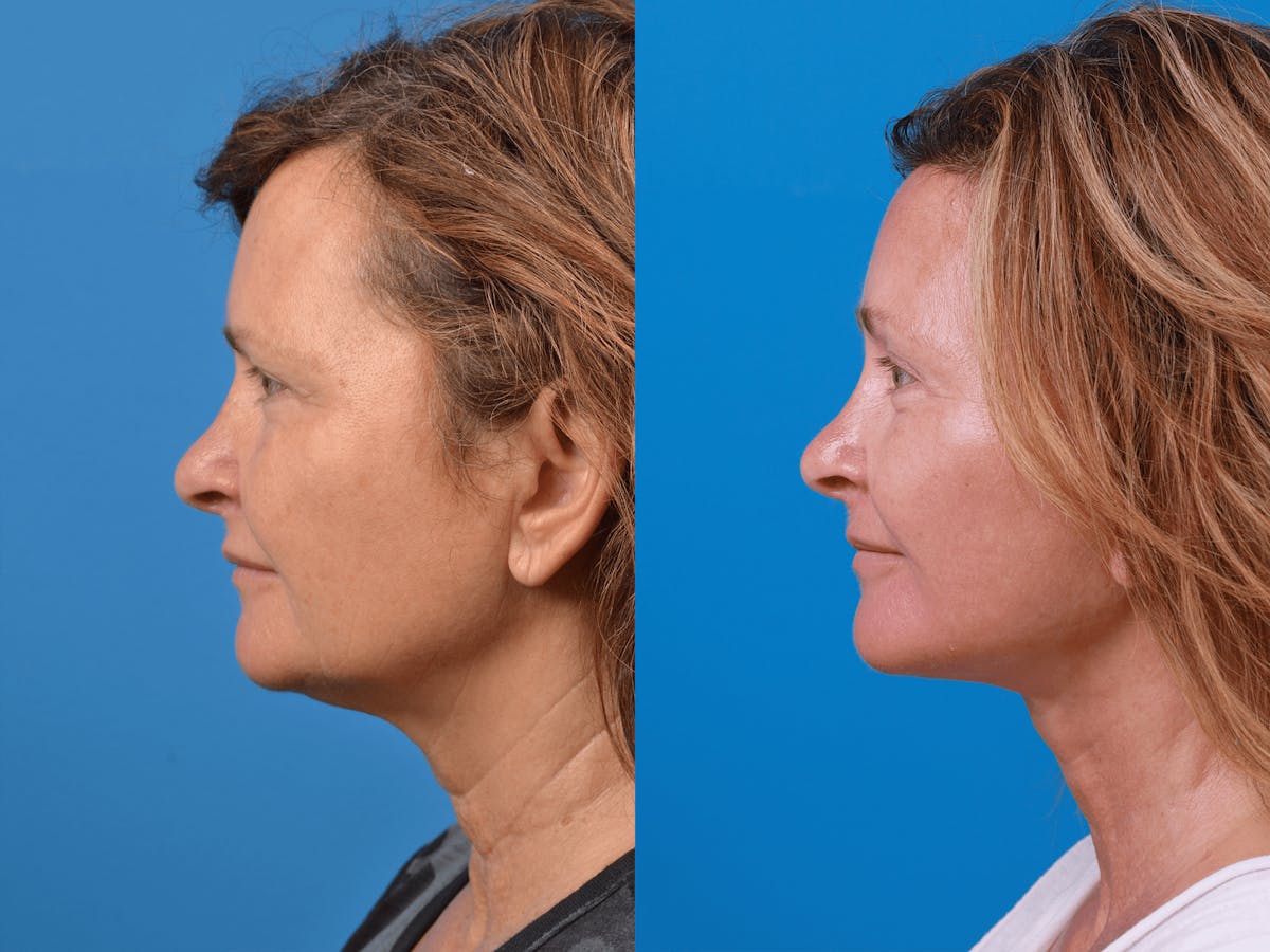 Facelift Before & After Gallery - Patient 122406177 - Image 2