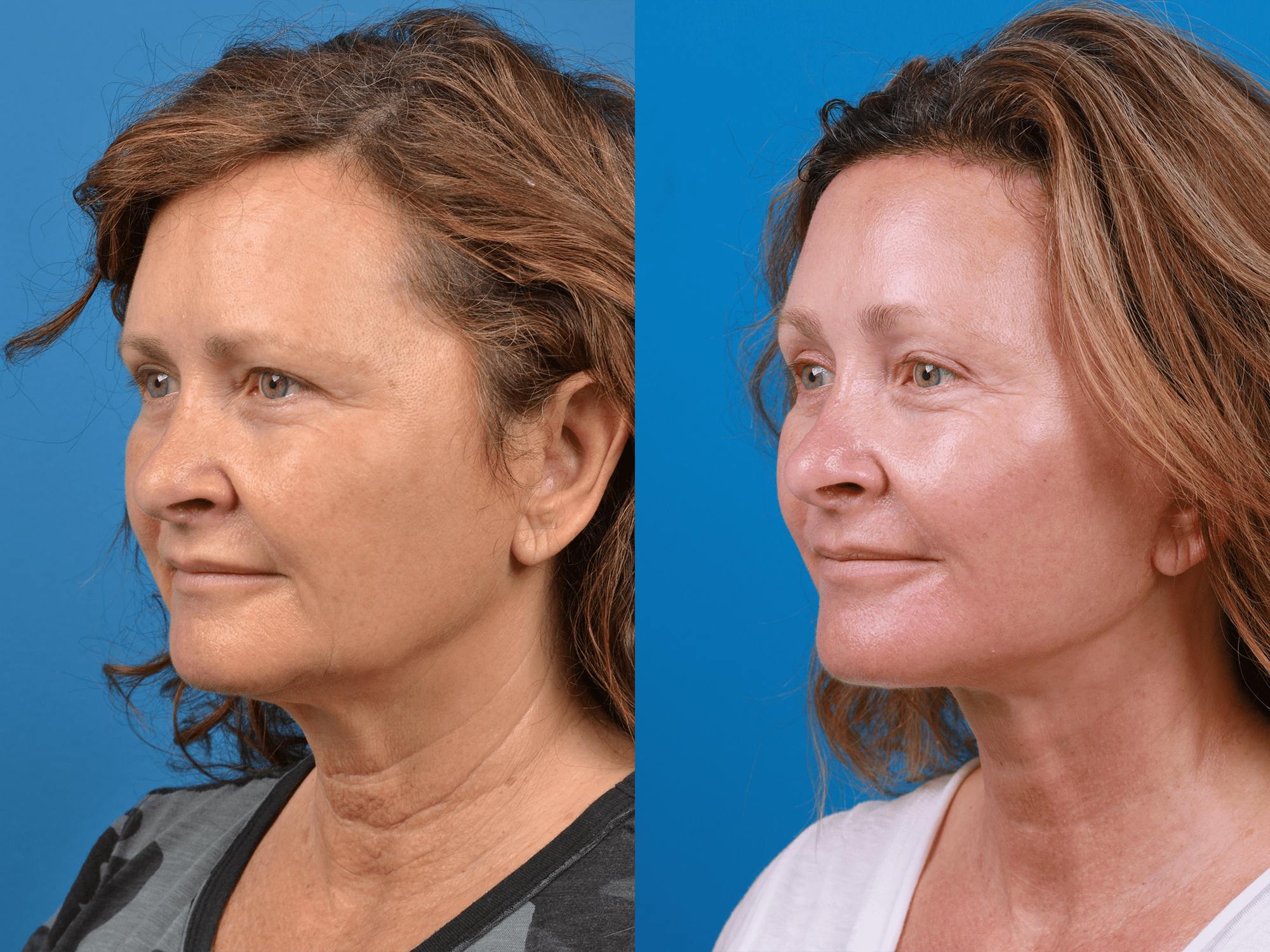 Facelift Before & After Gallery - Patient 122406177 - Image 3