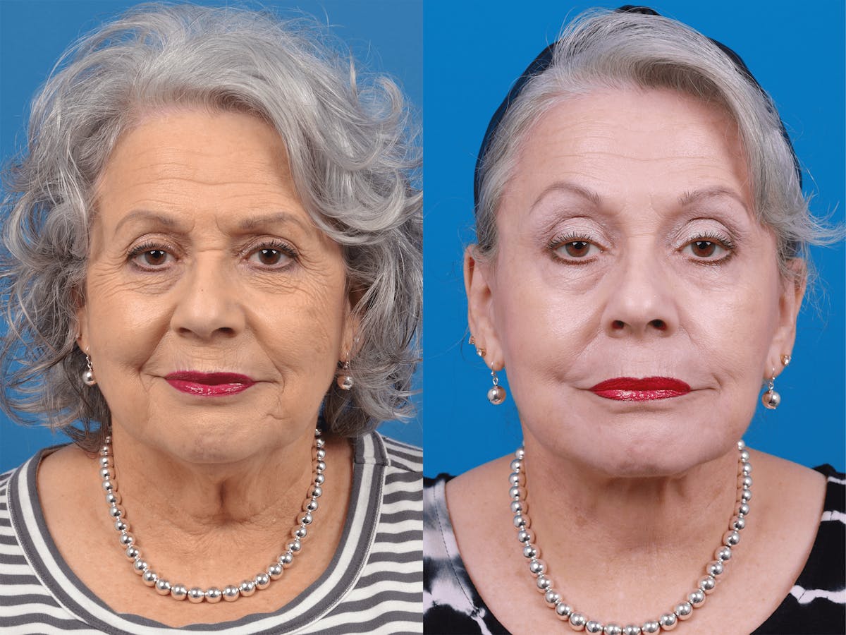 Facelift Before & After Gallery - Patient 122406178 - Image 1