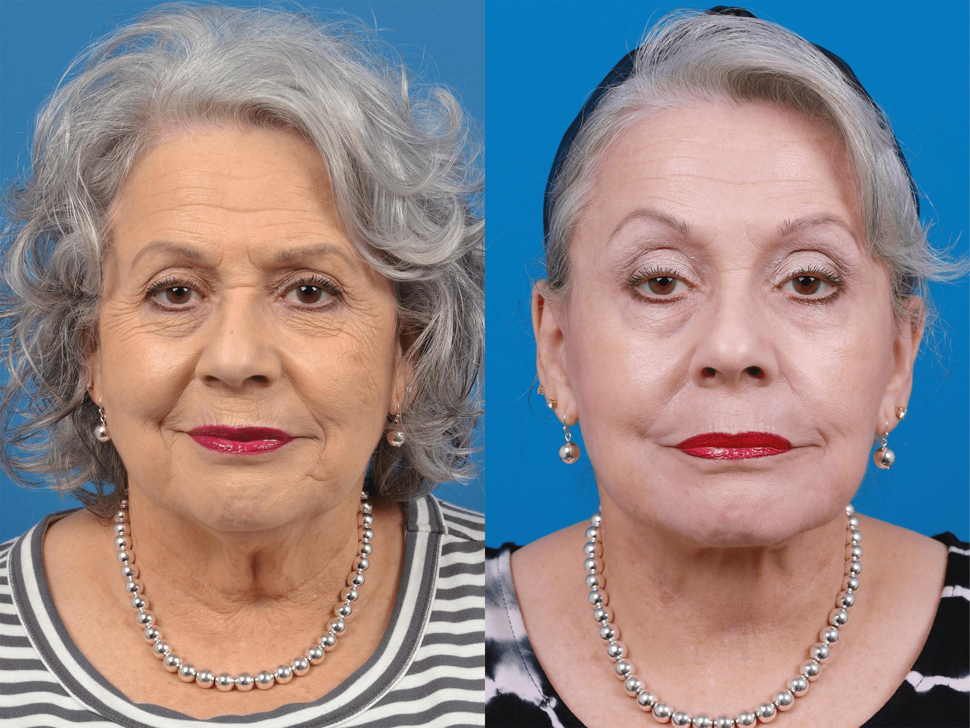 Facelift Before & After Gallery - Patient 122406178 - Image 1