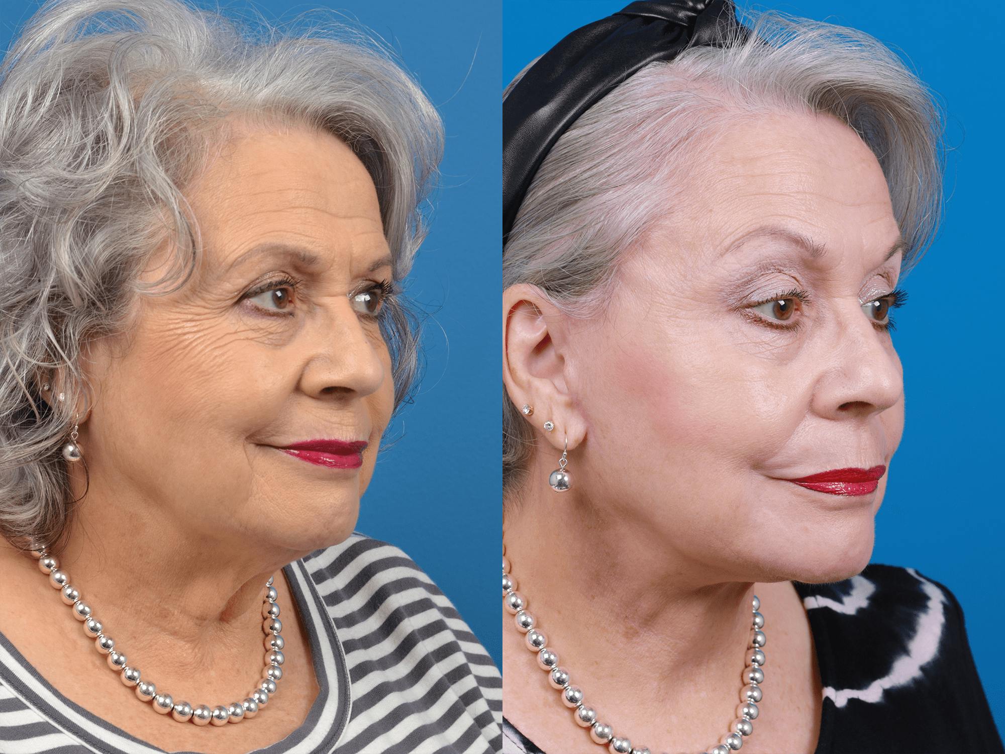 Facelift Before & After Gallery - Patient 122406178 - Image 2