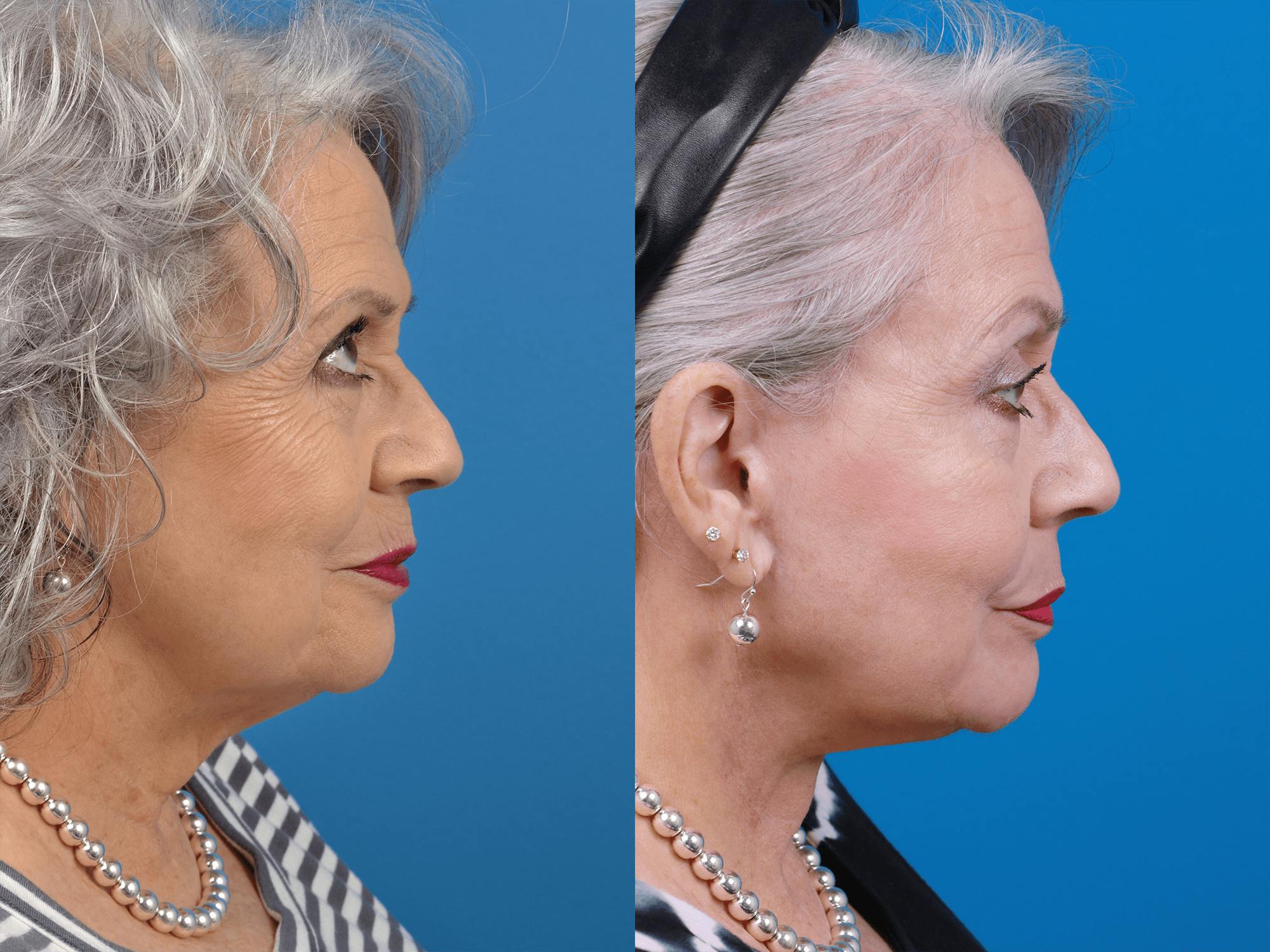 Facelift Before & After Gallery - Patient 122406178 - Image 3