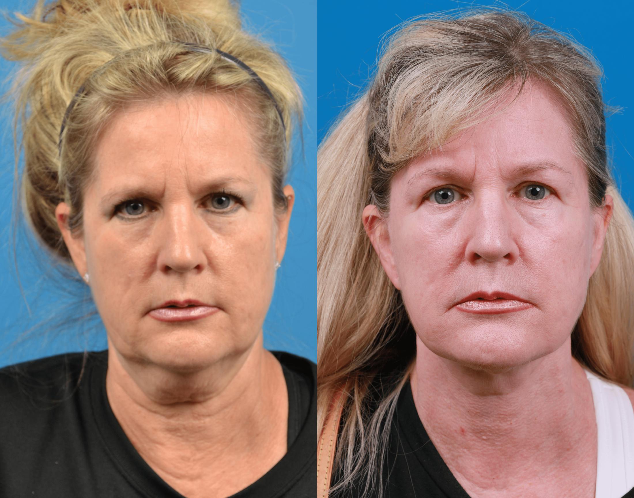 Facelift Before & After Gallery - Patient 122406180 - Image 1