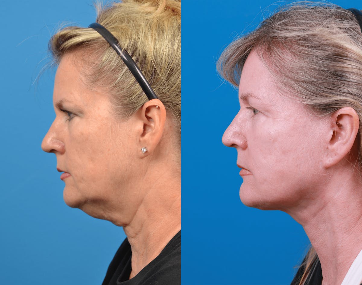 Facelift Before & After Gallery - Patient 122406180 - Image 2