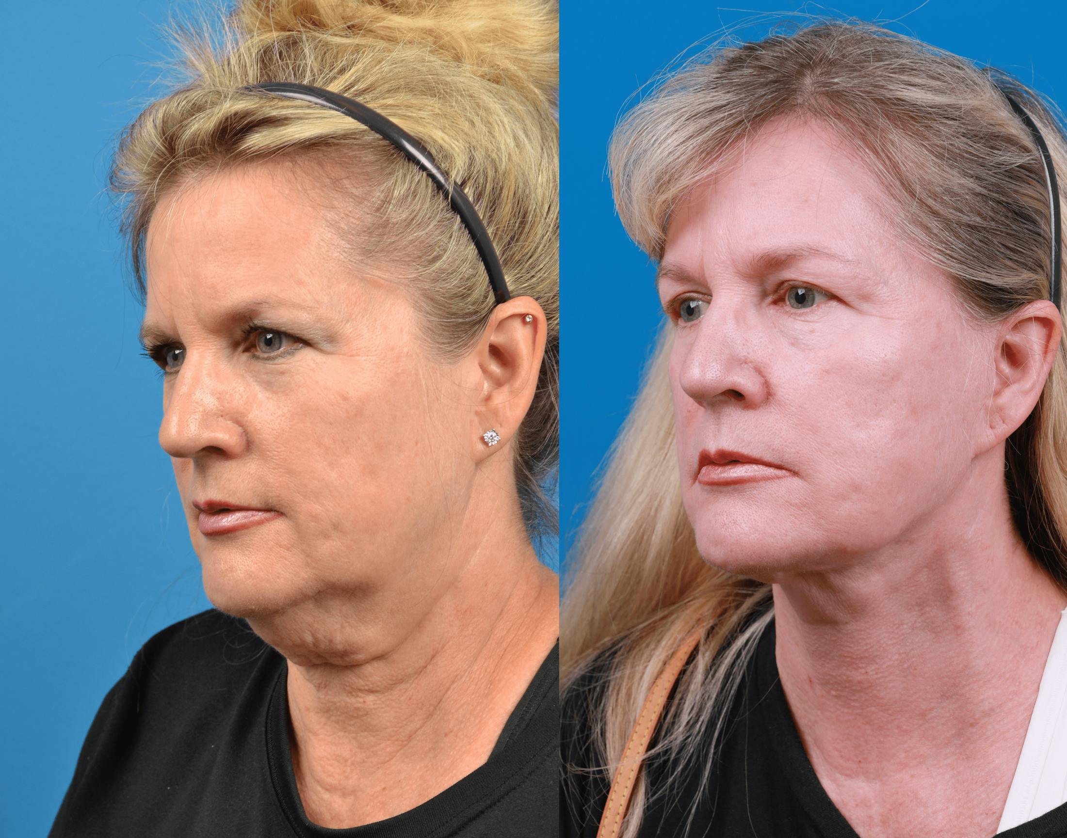 Facelift Before & After Gallery - Patient 122406180 - Image 3