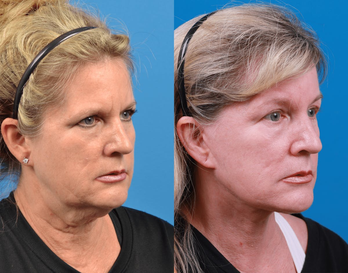 Facelift Before & After Gallery - Patient 122406180 - Image 4