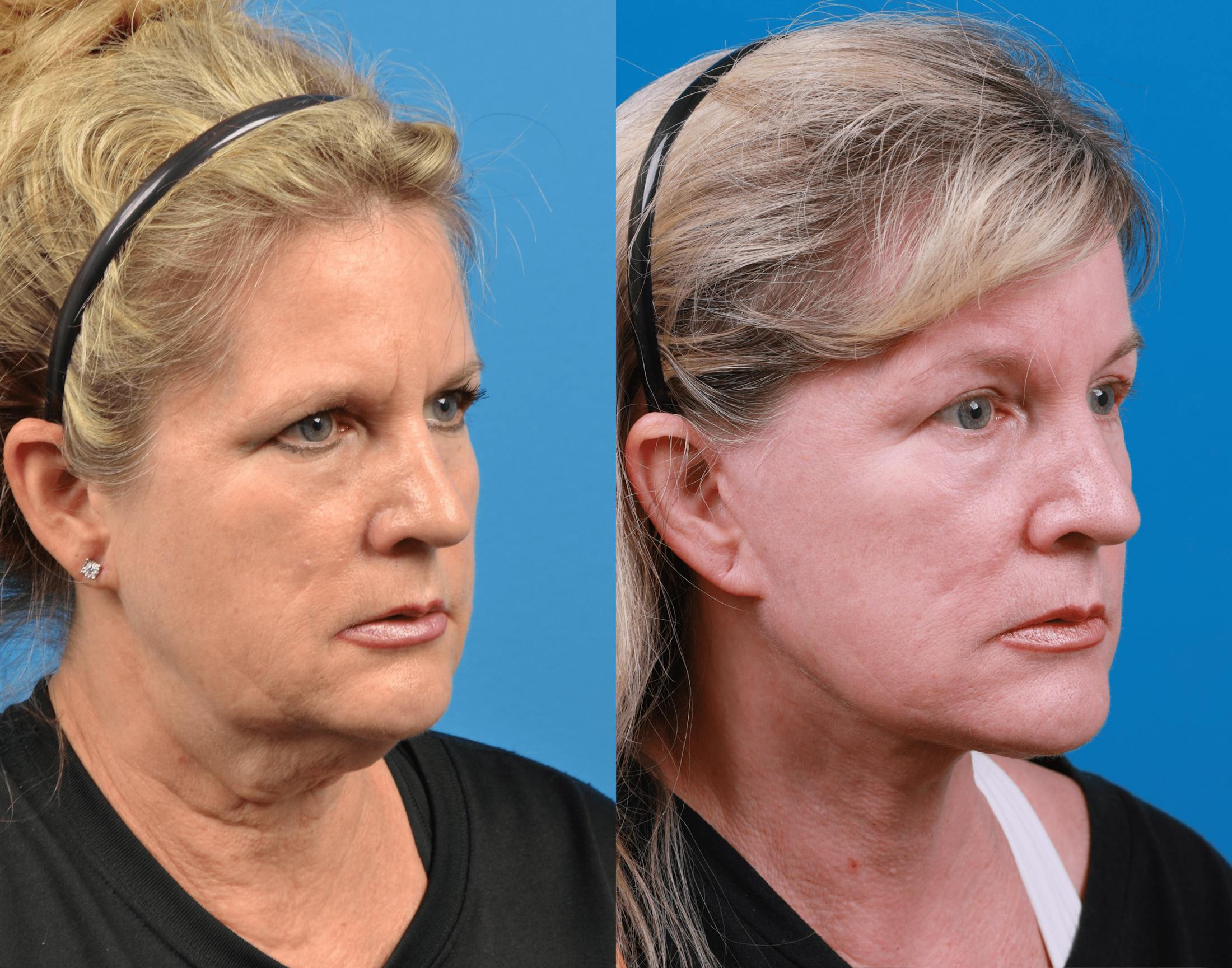 Facelift Before & After Gallery - Patient 122406180 - Image 4