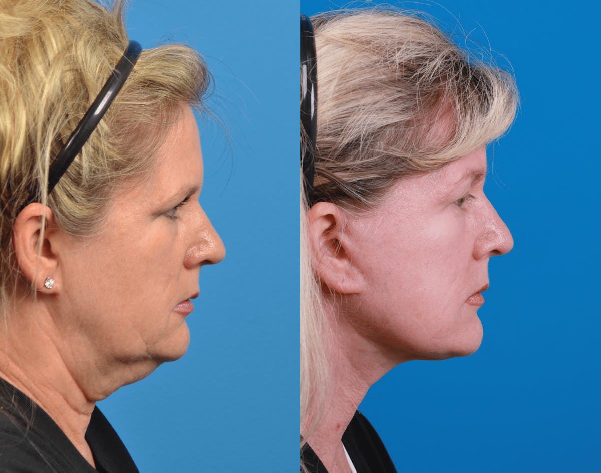 Facelift Before & After Gallery - Patient 122406180 - Image 5