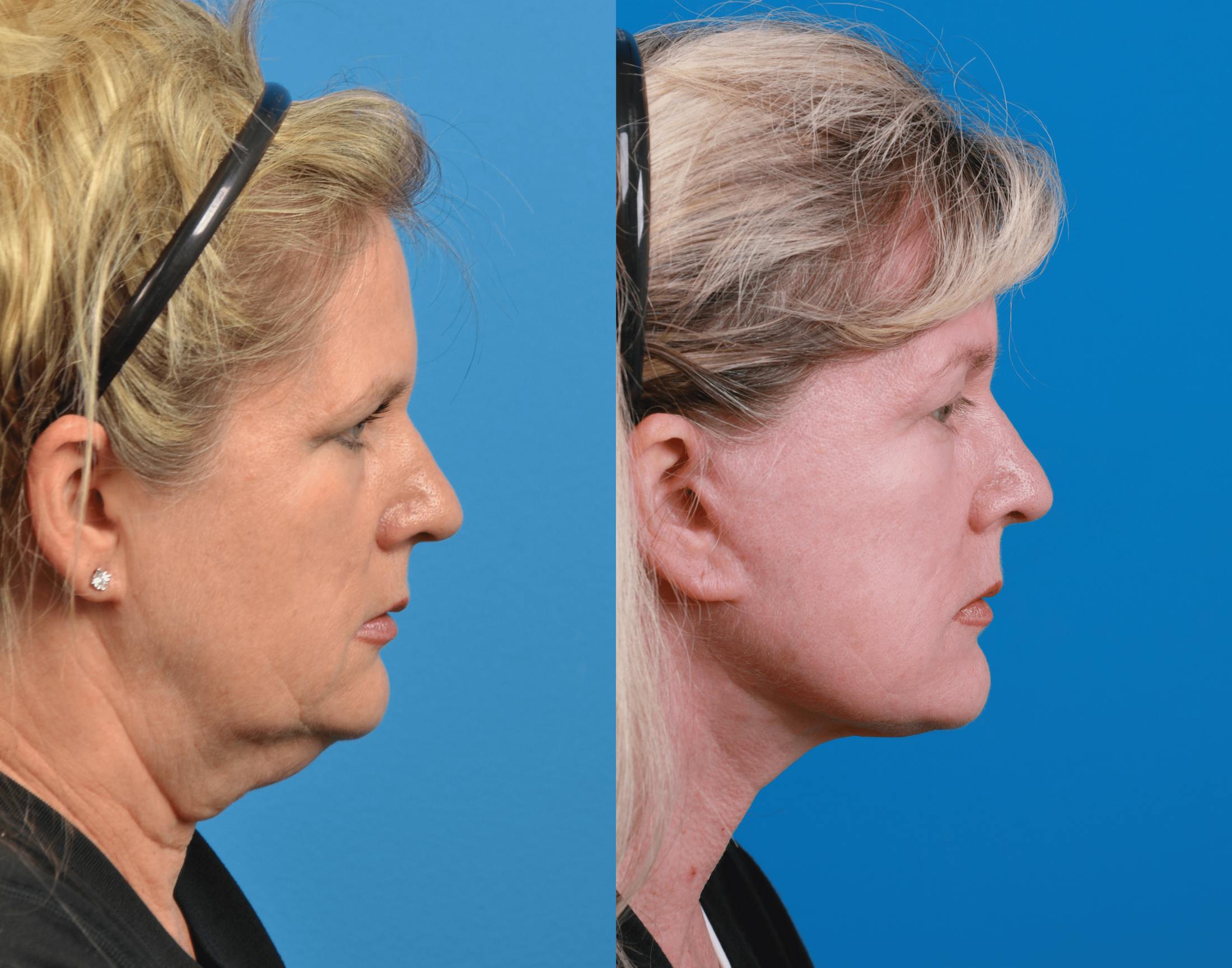Facelift Before & After Gallery - Patient 122406180 - Image 5