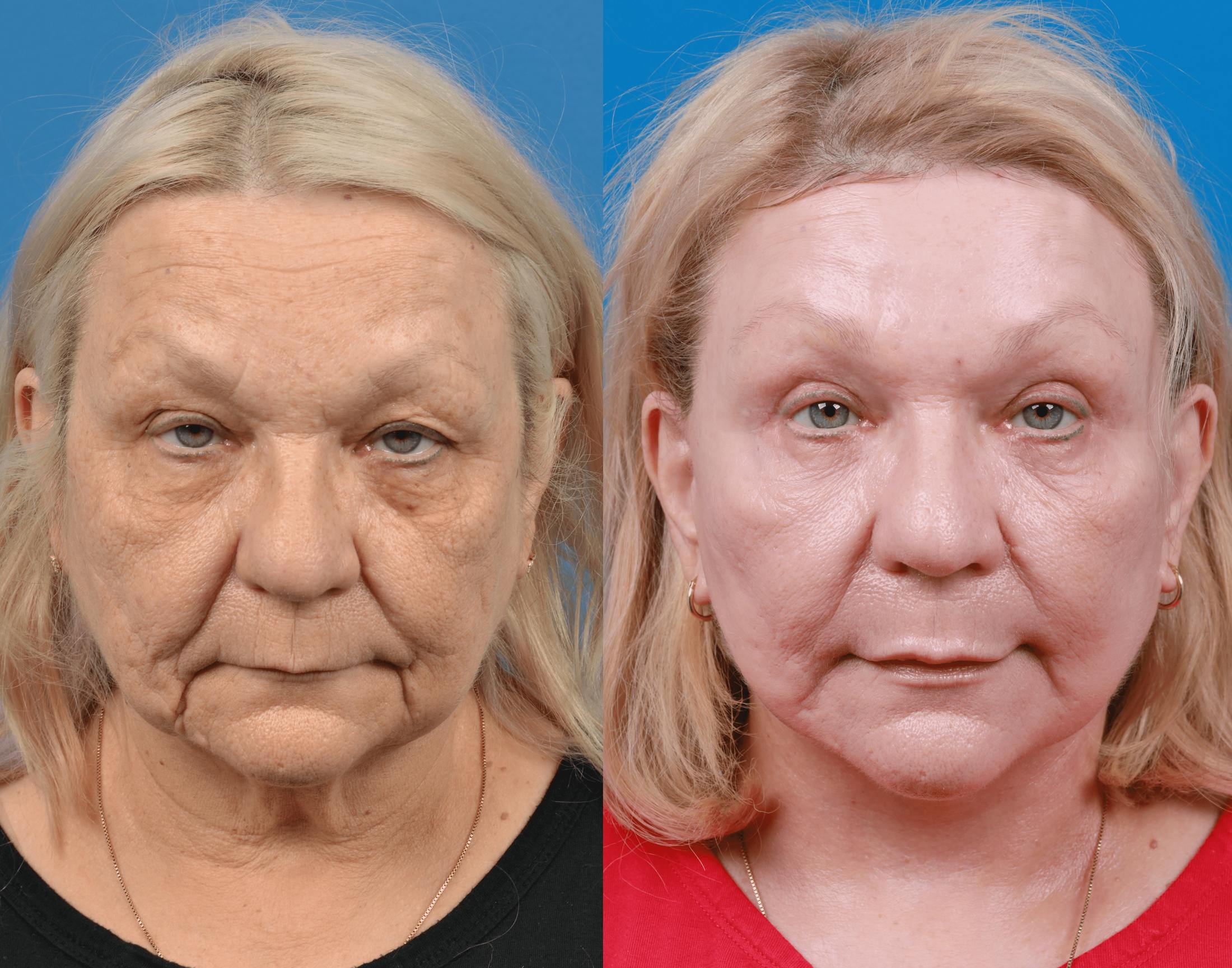 Facelift Before & After Gallery - Patient 122406181 - Image 1