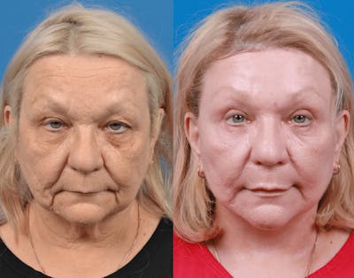 Facelift Before & After Gallery - Patient 122406181 - Image 1
