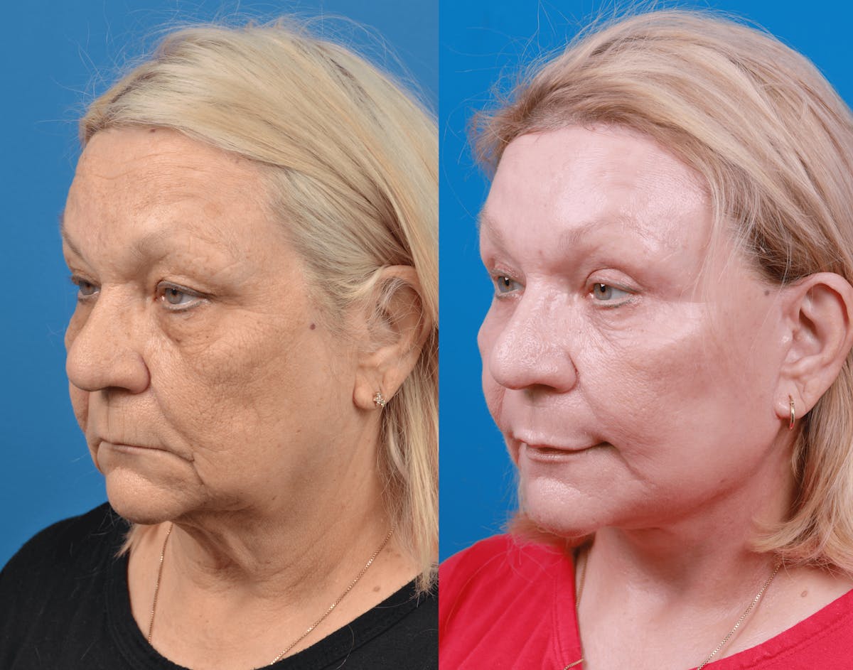 Facelift Before & After Gallery - Patient 122406181 - Image 2