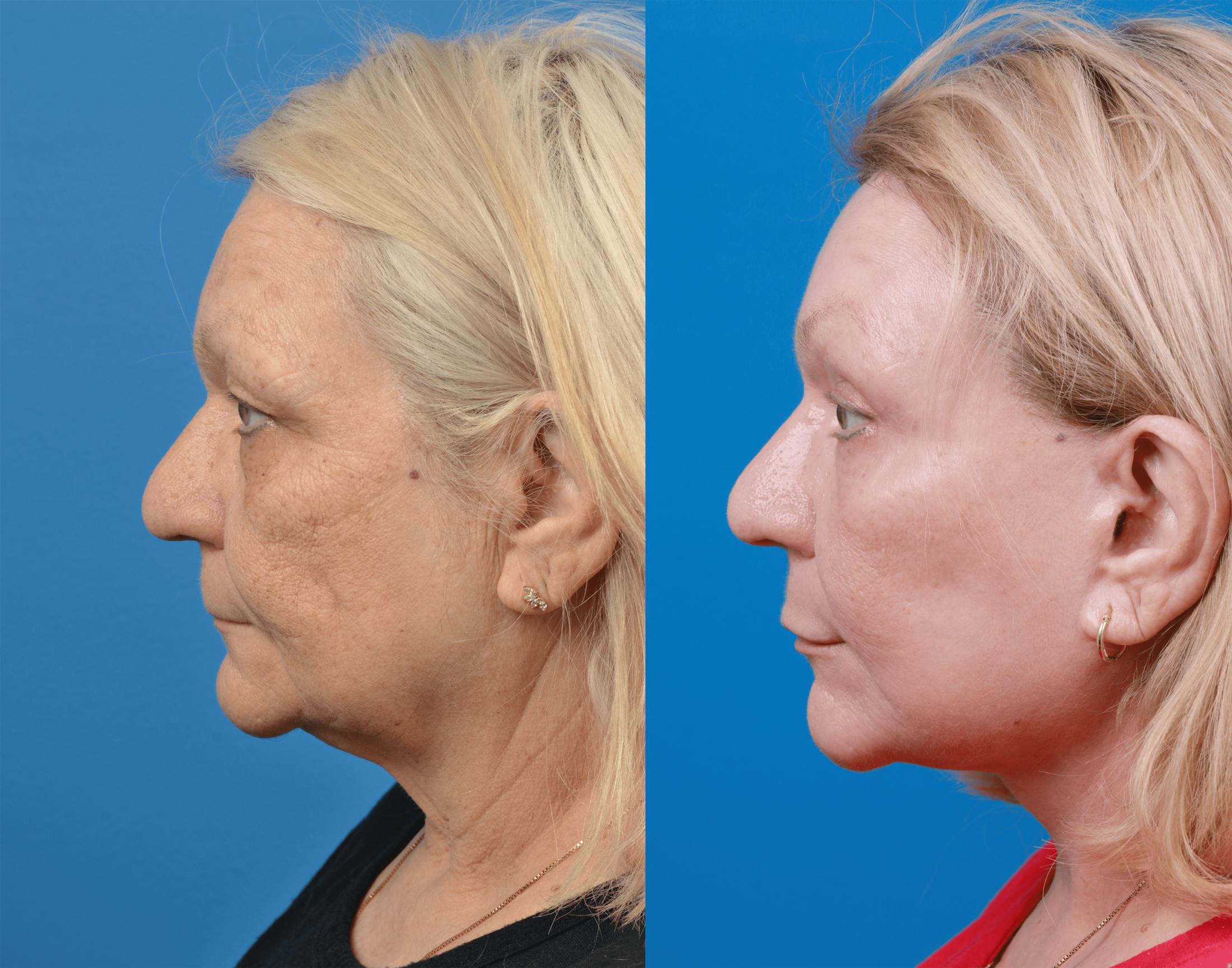 Facelift Before & After Gallery - Patient 122406181 - Image 3
