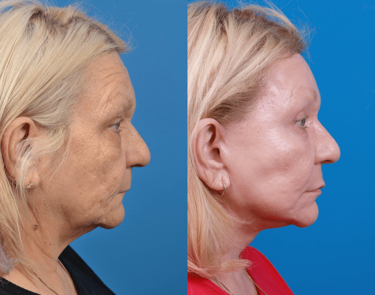 Facelift Before & After Gallery - Patient 122406181 - Image 4
