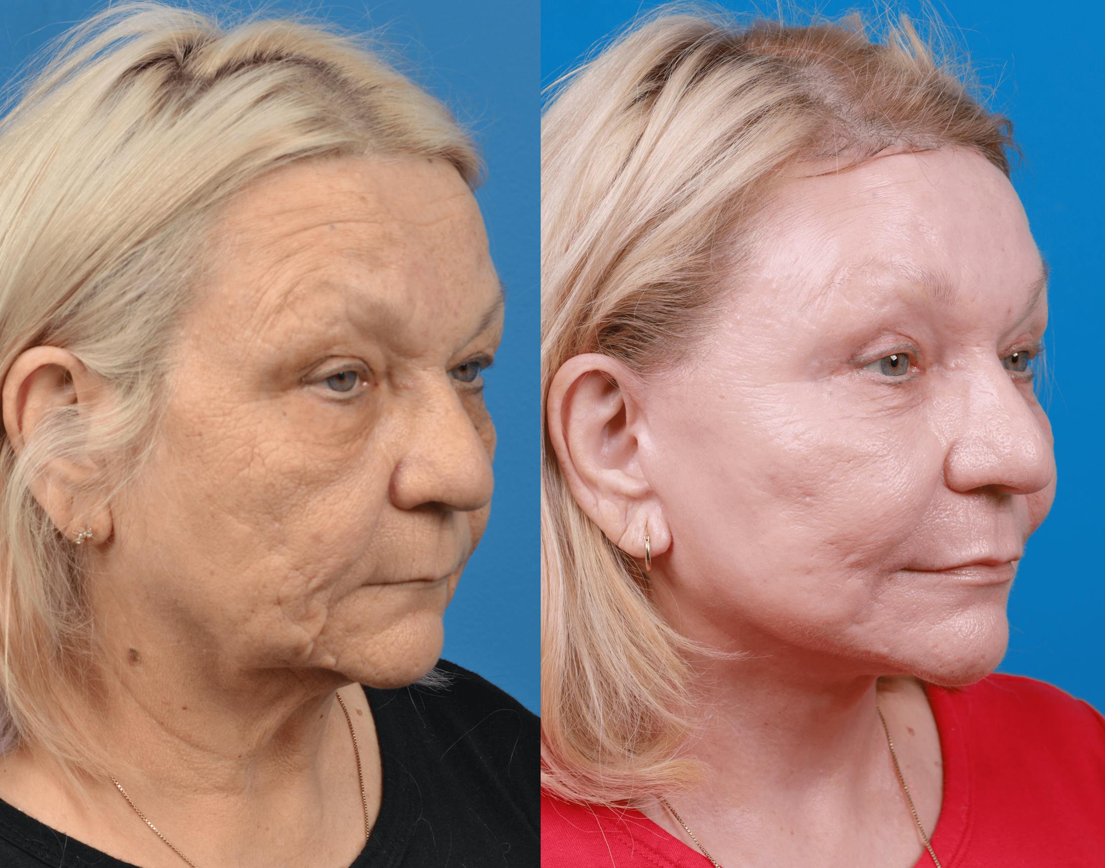 Facelift Before & After Gallery - Patient 122406181 - Image 5