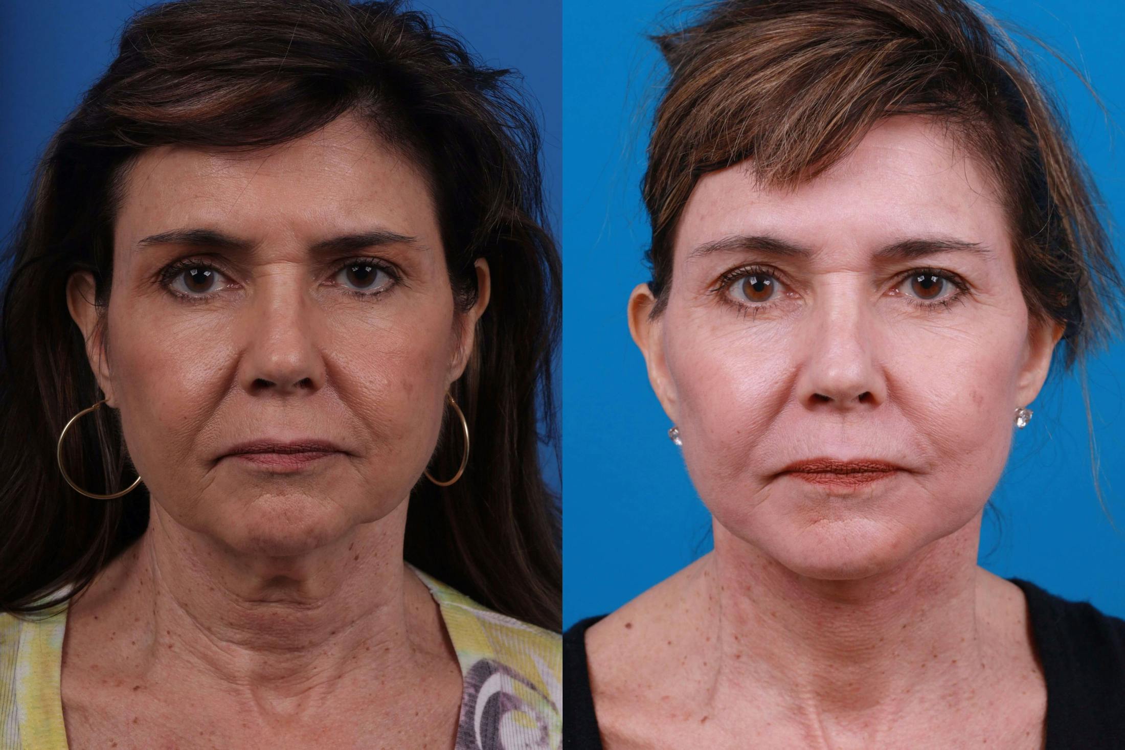 Facelift Before & After Gallery - Patient 122406183 - Image 1