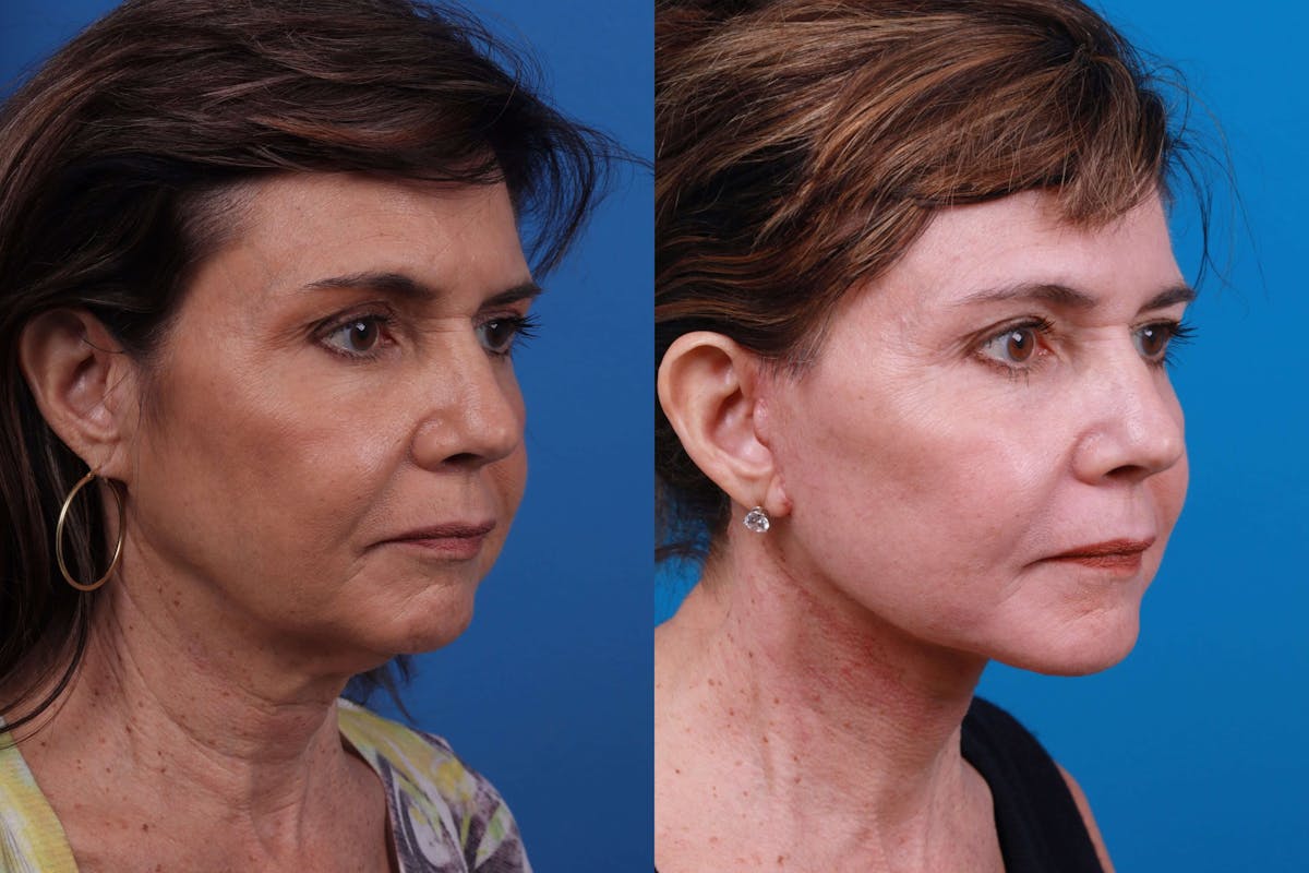 Facelift Before & After Gallery - Patient 122406183 - Image 2