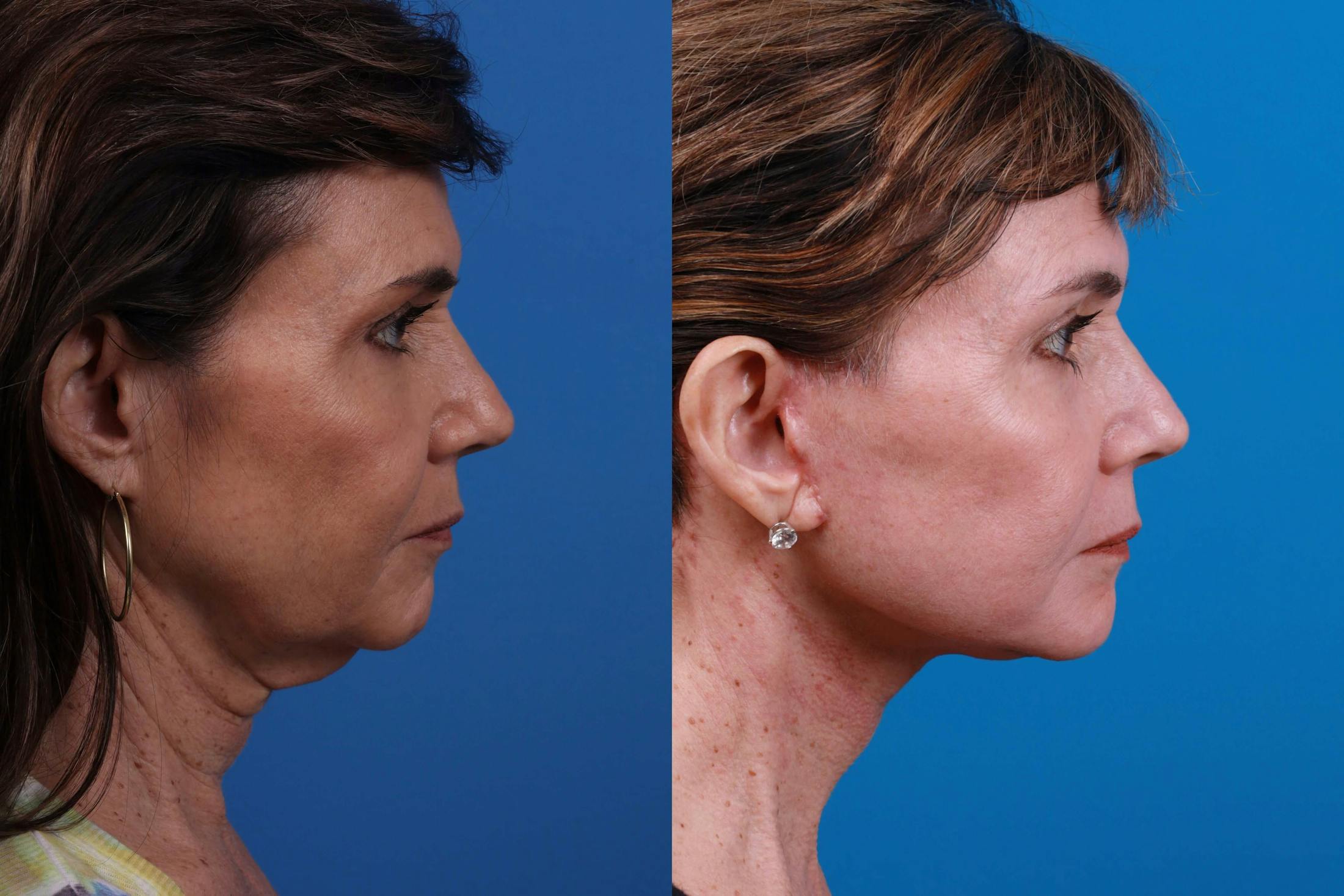 Facelift Before & After Gallery - Patient 122406183 - Image 3