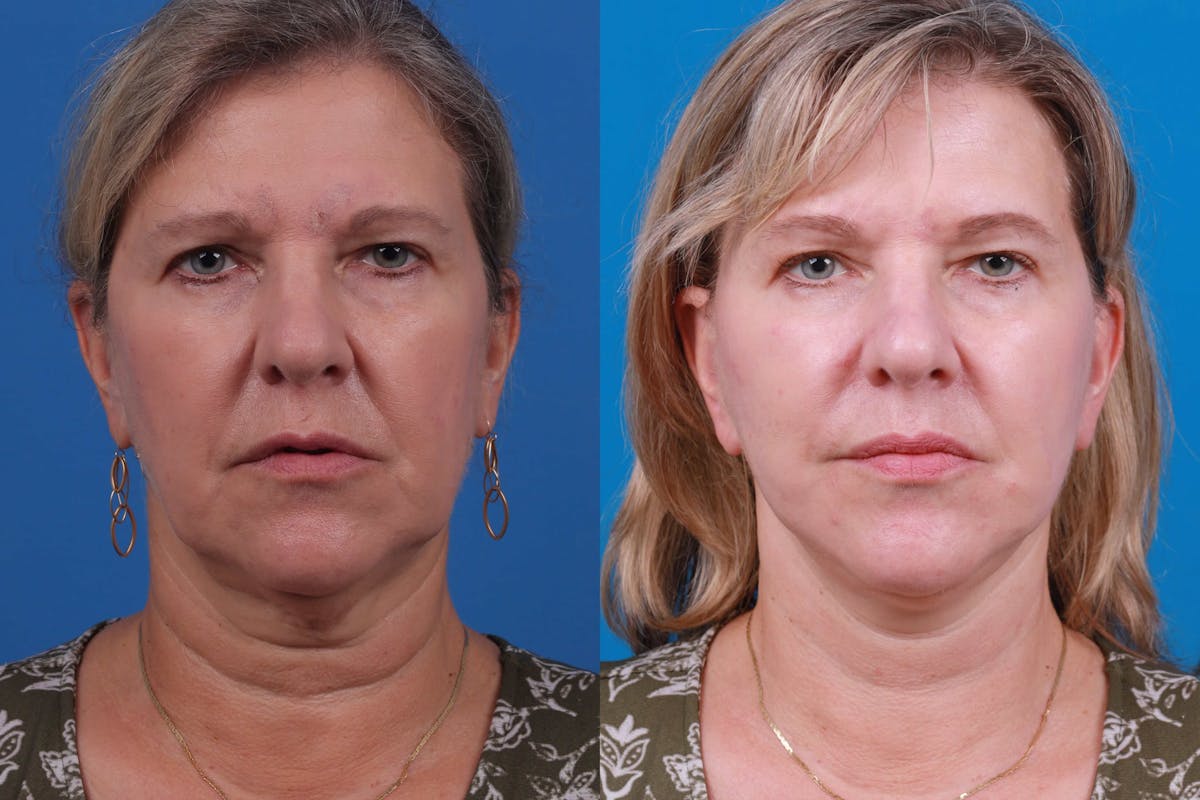 Facelift Before & After Gallery - Patient 122406184 - Image 1