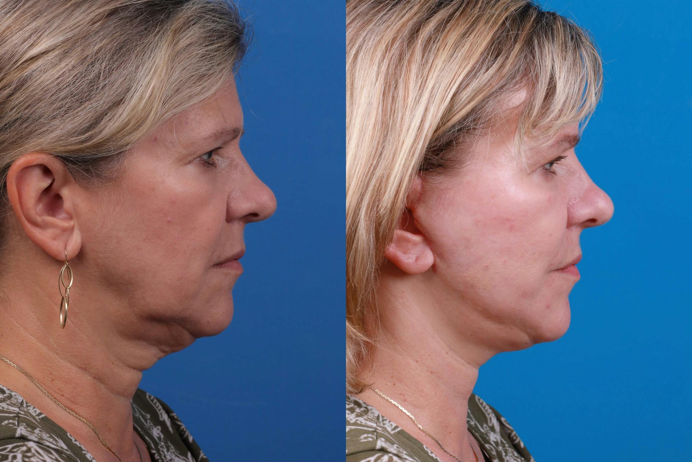 Facelift Before & After Gallery - Patient 122406184 - Image 2