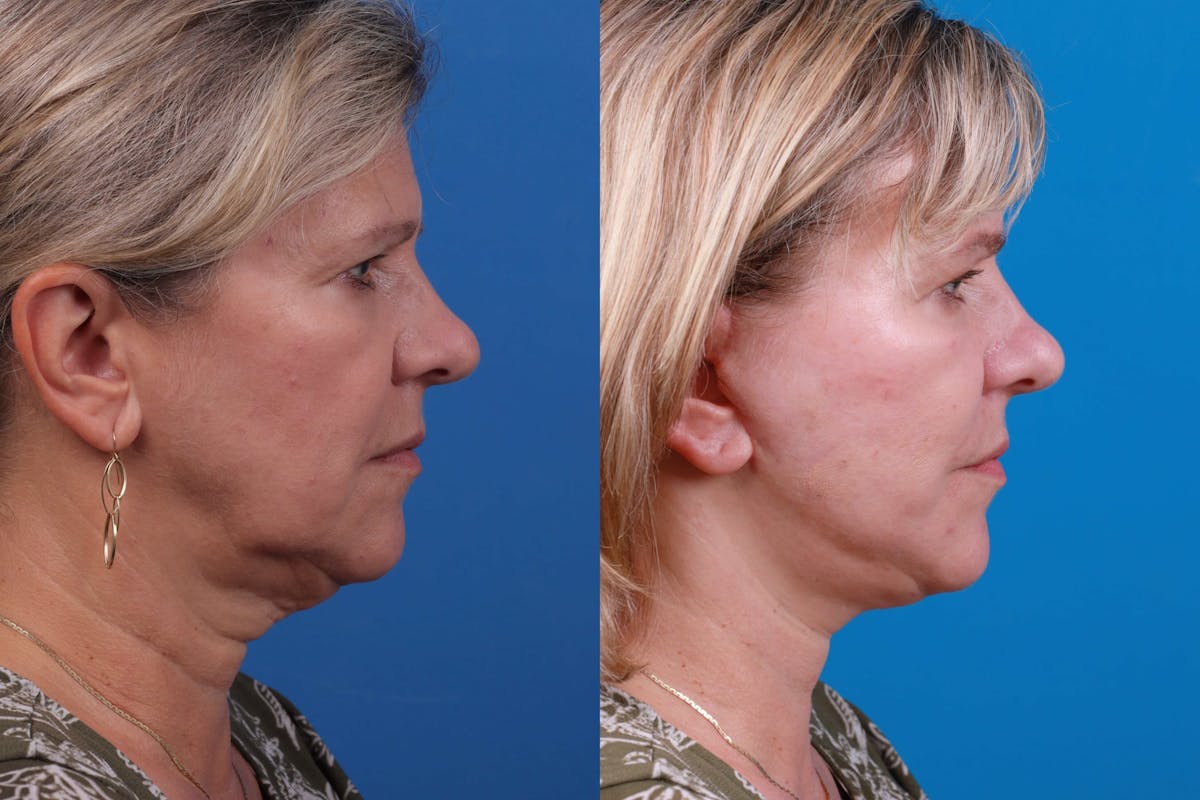 Facelift Before & After Gallery - Patient 122406184 - Image 2