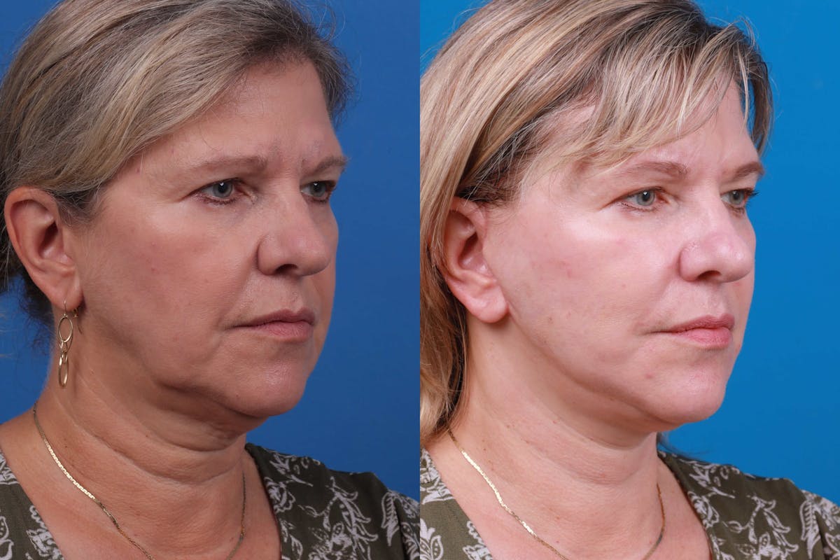 Facelift Before & After Gallery - Patient 122406184 - Image 3