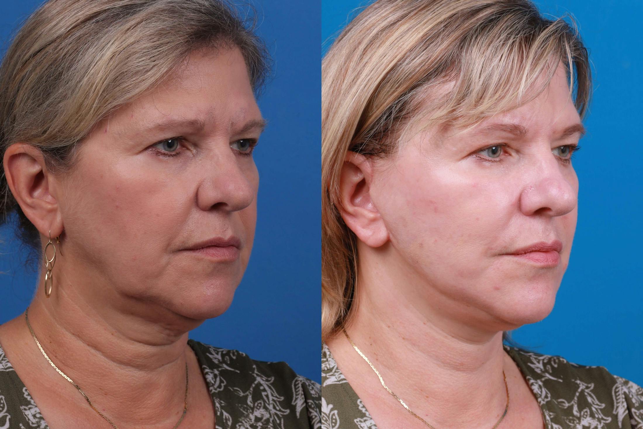 Facelift Before & After Gallery - Patient 122406184 - Image 3