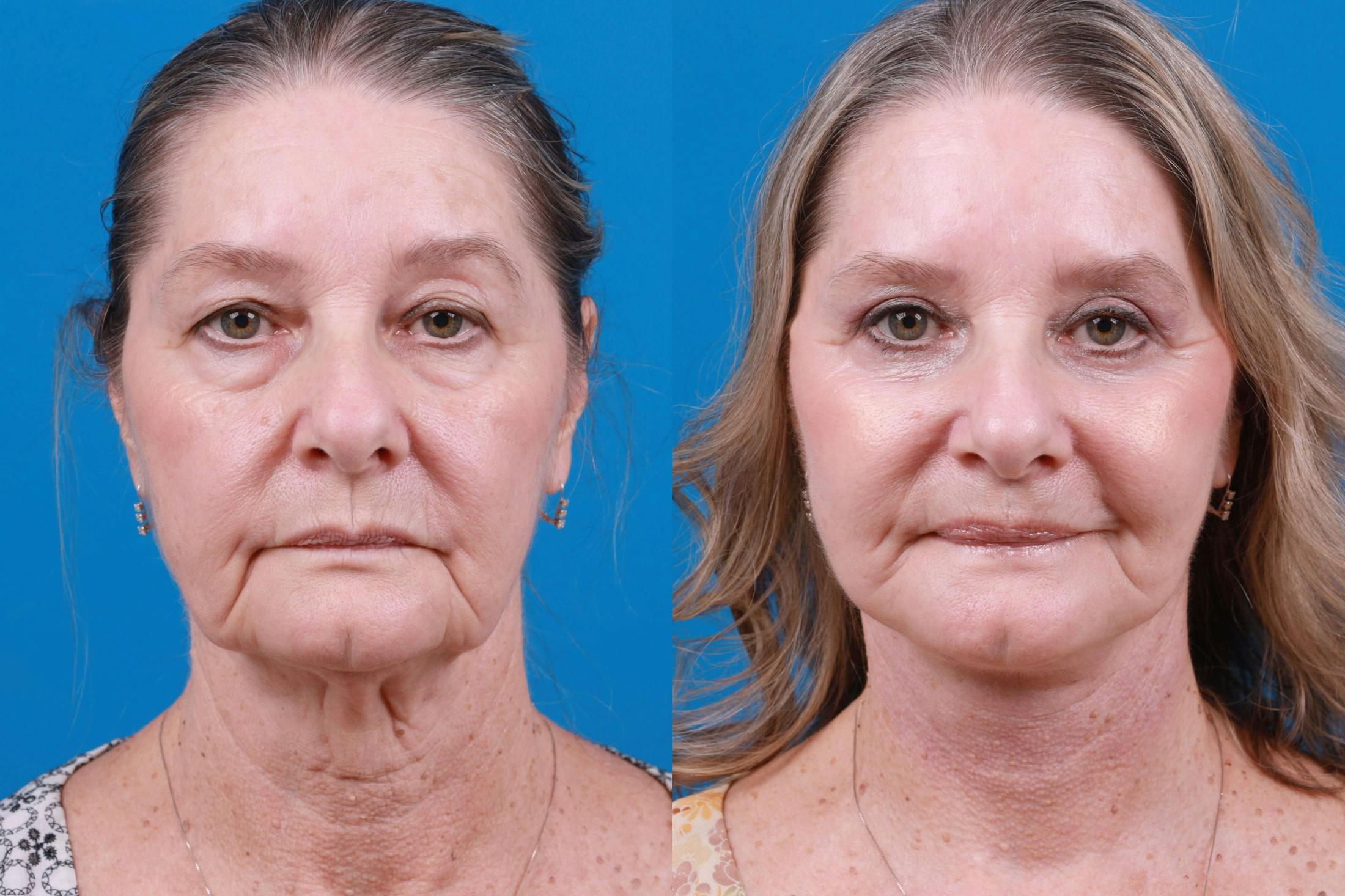 Facelift Before & After Gallery - Patient 122406185 - Image 1