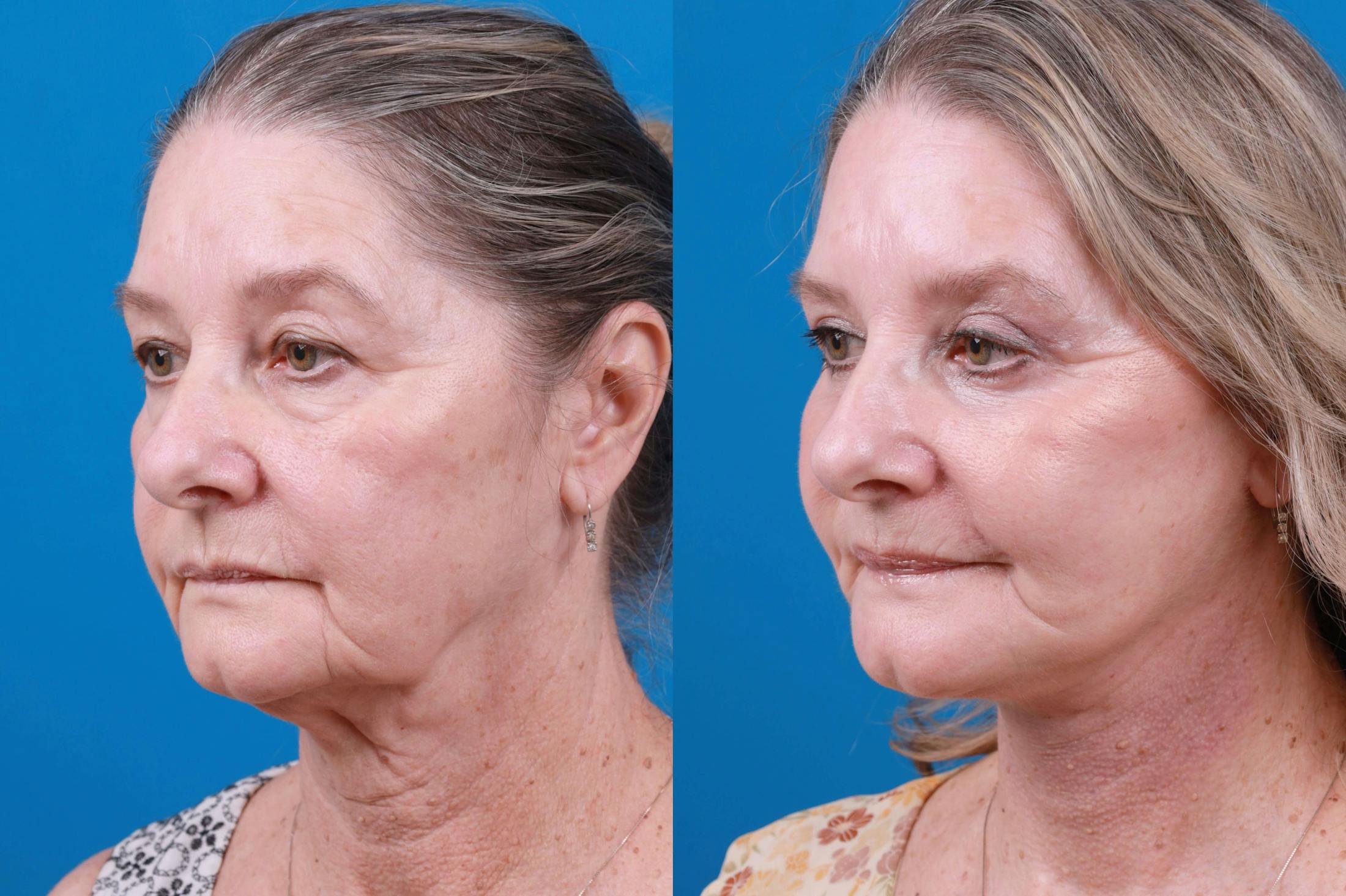 Facelift Before & After Gallery - Patient 122406185 - Image 2