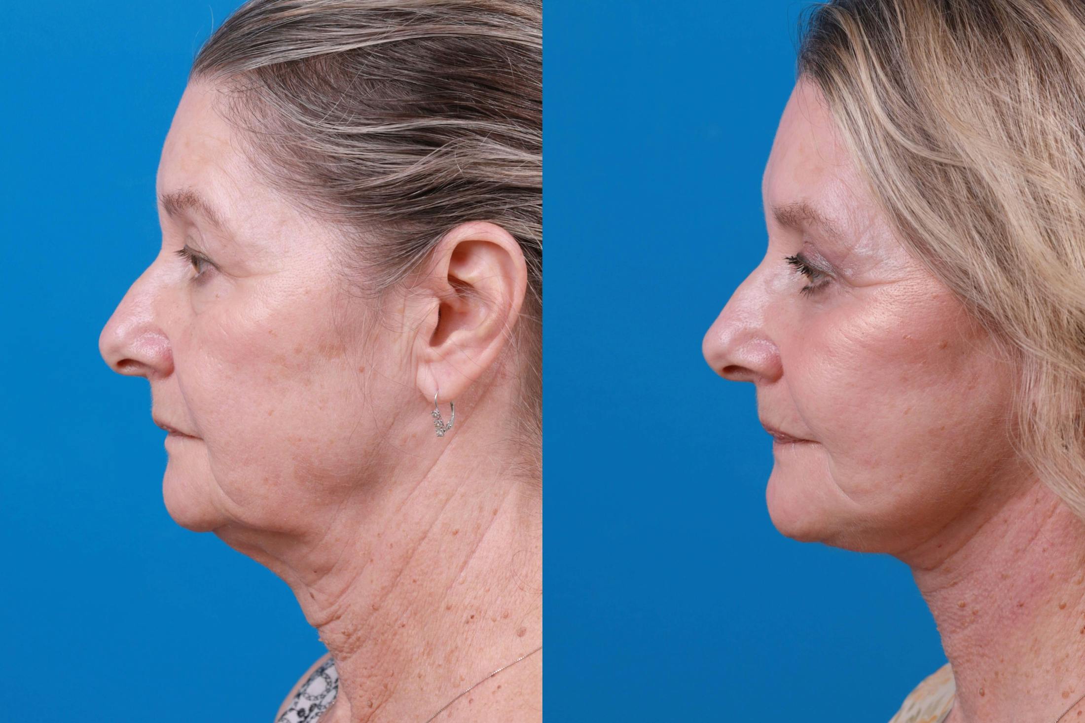 Facelift Before & After Gallery - Patient 122406185 - Image 3