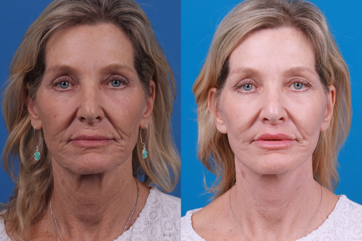 Facelift Before & After Gallery - Patient 122406187 - Image 1